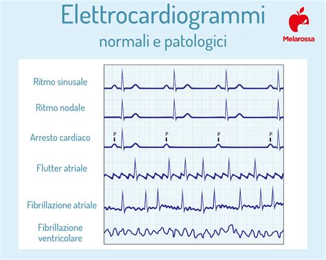 Elettrocardiogramma 